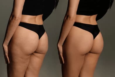 diete per la cellulite